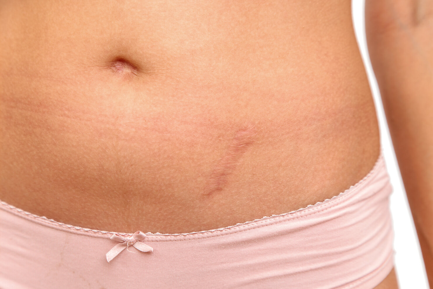 Vancouver Laser Scar Removal Scar Revision Surrey Surgery Injections